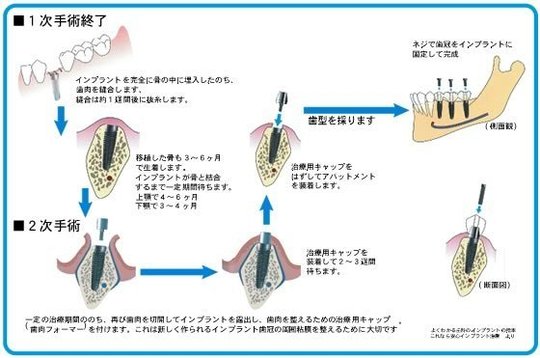 【裁断済み】コンベンショナル・ボンディッド・インプラントレストレーション 裁断済み】コンベンショナル・ボンディッド・インプラントレスト