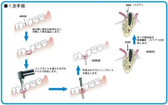 インプラント治療 - 矢野歯科医院（高槻市摂津富田）