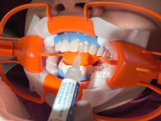 ホワイトニング - 矢野歯科医院（高槻市摂津富田）